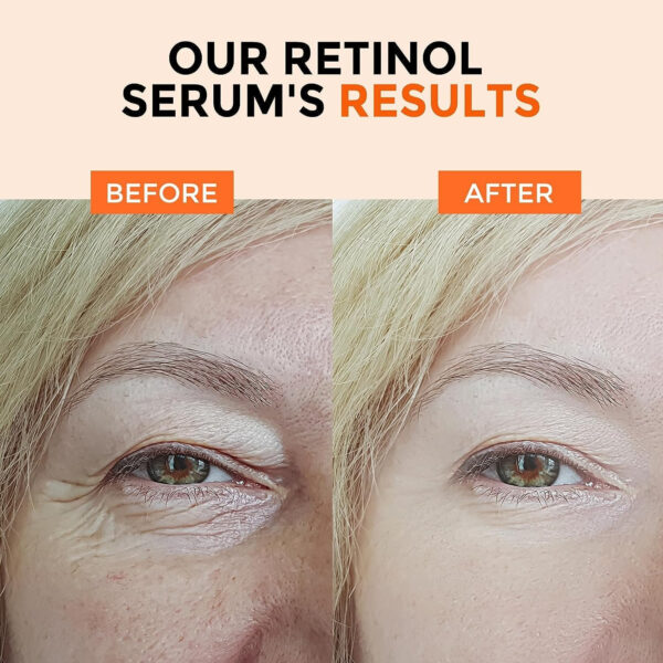 Retinol Serum for Face 2.5%, B5 Resurfacing Retinol Serum with Vitamin C, Vitamin E, Hyaluronic Acid, Niacinamide, Peptide for Anti-Aging, Wrinkle Smoothing, Dark Spot Corrector, Brighten Dullness